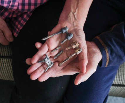 Susan Ottele and Adam Collier’s father, Will Collier, hold the broken screws removed from their son’s back